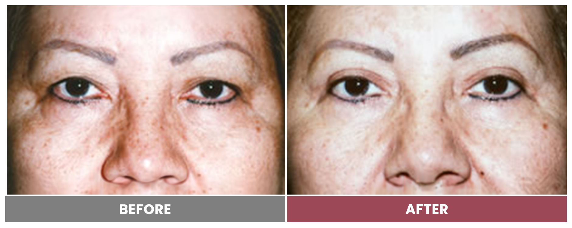 Upper Blepharoplasty - Case 63